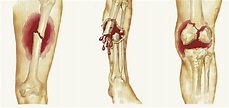 Straight, No Chaser: Open Fractures - Jeffrey Sterling, MD