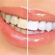 DIY Teeth Whitening: 5 Brilliant Tips for Whiter Teeth That Work ...