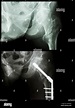 Intertrochanteric fractura de fémur izquierdo (fractura del hueso del ...