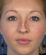 Example of San Diego Rhinoplasty With Spreader Grafting