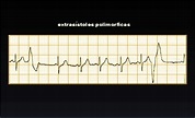 ECG 7.8 Arritmias ventriculares - Cardio Science