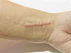 Cicatrices, tratamientos y fisioterapia