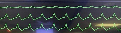 What’s the most strangest “WTF” heart rhythms that y’all have ever seen ...