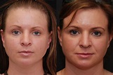 Facial Liposuction Photos | Cincinnati, OH | Patient 6846