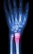 Different Types Of Wrist Fractures? | The Bone & Joint Center