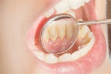 Dental Tartar (Calculus) - Causes, Prevention and Removal