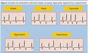Figura 3. Ejemplos de extrasístole ventricular aislada, en pareja ...