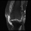 Medial collateral ligament bursa | Radiology Reference Article ...