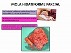 Mola hidatiforme, cuidados de enfermeria y DIAGNOSTICOS NANDA