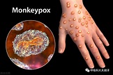 一例猴痘病毒输入性病例在重庆确诊，普通人该如何预防猴痘感染_腾讯新闻
