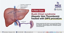 Budd-Chiari syndrome (Hepatic Vein Thrombosis) - DIPS procedure