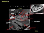 This image is the most typical hippocampal image seen in a coronal ...