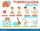 Top 18 mejores tuberculosis sintomas causas y tratamiento en 2022