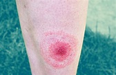 What Does a Lyme Disease Rash Really Look Like? These Pictures Explain ...