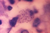 Granuloma inguinale - microbewiki