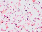 Listeria Meningitis: An Inconsistent Organism Causing an Inconsistent ...