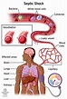 Septic Shock: Causes, Symptoms & Treatment