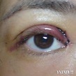割雙眼皮失敗圖片大全 常見的4個手術失敗情況介紹 - 色彩地帶