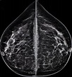 Mammogram radio imaging for breast cancer diagnosis - ODC