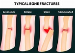 Typical bone fractures - The Oshman Firm