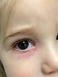 VIRTUAL GRAND ROUNDS IN DERMATOLOGY 2.0: Periocular Dermatitis in a Child