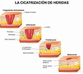 Las 4 fases principales de la cicatrización de heridas | Shield HealthCare