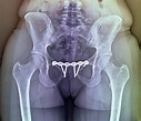 'pinned Pelvic Fracture Photograph by Zephyr/science Photo Library ...