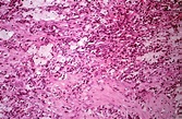 Donovanosis (granuloma inguinale): skin lesion | Wellcome Collection