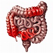 Enfermedad de Crohn: Estos son síntomas a los que debes estar atento ...