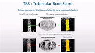 How to use TBS (Trabecular Bone Score) in combination with BMD in ...