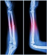 Bone Fracture: Who’s Vulnerable? And How Can You Lower Your Risk ...