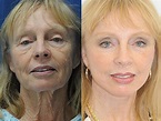 Facelift in Beverly Hills | Beverly Hills Facelift Institute