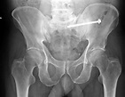 Fractura del pelvis posterior - osteosíntesis con tornillo - DocCheck