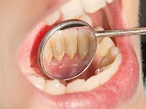 Sarro y los cálculos dentales - Qué son y qué debes hacer para evitarlos