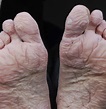 Trench foot: Symptoms, causes, treatment