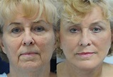 Vertical Facelift in Beverly Hills Surgery | Beverly Hills Facelift ...