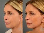 Facelift Before and After | Deep Plane Facelift Recovery | Beverly ...