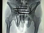 Fractura de pelvis: Una lesión compleja de tratar - Policlínica ...