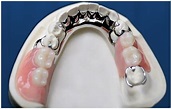 Prótese Dentária, saiba tudo – Sorriso de Monalisa Odontologia