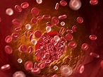 Las anomalías en coagulación de la sangre revelan qué pacientes corren ...