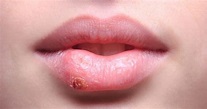 Herpes en la boca: síntomas, por qué aparecen y tratamiento - Maestria ...