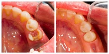 Direct pulp capping of the tooth in cases of pulpitis