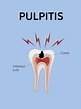 Pulpitis - Quatre Dental