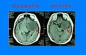 腦血管瘤 - A+醫學百科