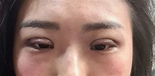 【斗六吳景文】縫雙眼皮分享-14Weeks全紀錄 - 女孩板 | Dcard