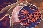 Penyakit TBC – Penyebab, Gejala, dan Pengobatan