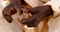 Leprosy Fact Sheet | Africa Health Organisation