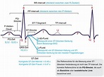 EKG-Interpretation: Merkmale des normalen EKGs (P-Welle, QRS-Komplex ...