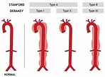 Aortic Dissection - Type A And B - Symptoms, Causes, Treatment