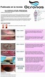 Póster: Úlceras por presión - Ocronos - Editorial Científico-Técnica